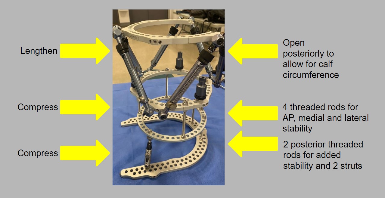 An Update on the Practical Management of a Hexapod System in Lower Limb